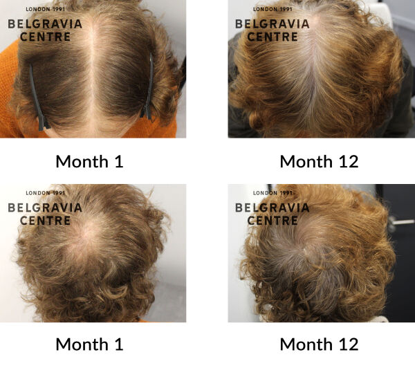 male pattern hair loss the belgravia centre 435678