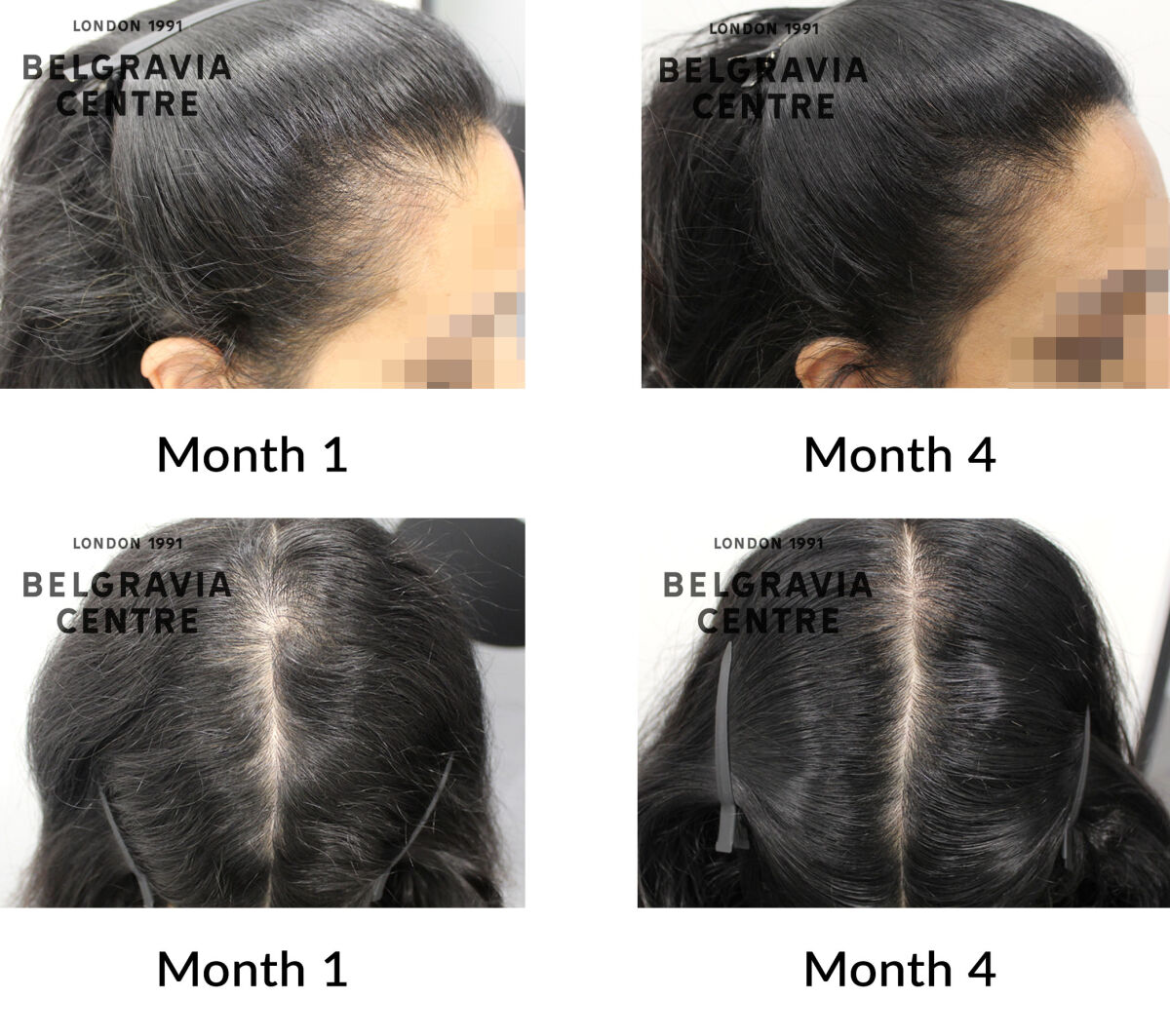 female pattern hair loss the belgravia centre 449729