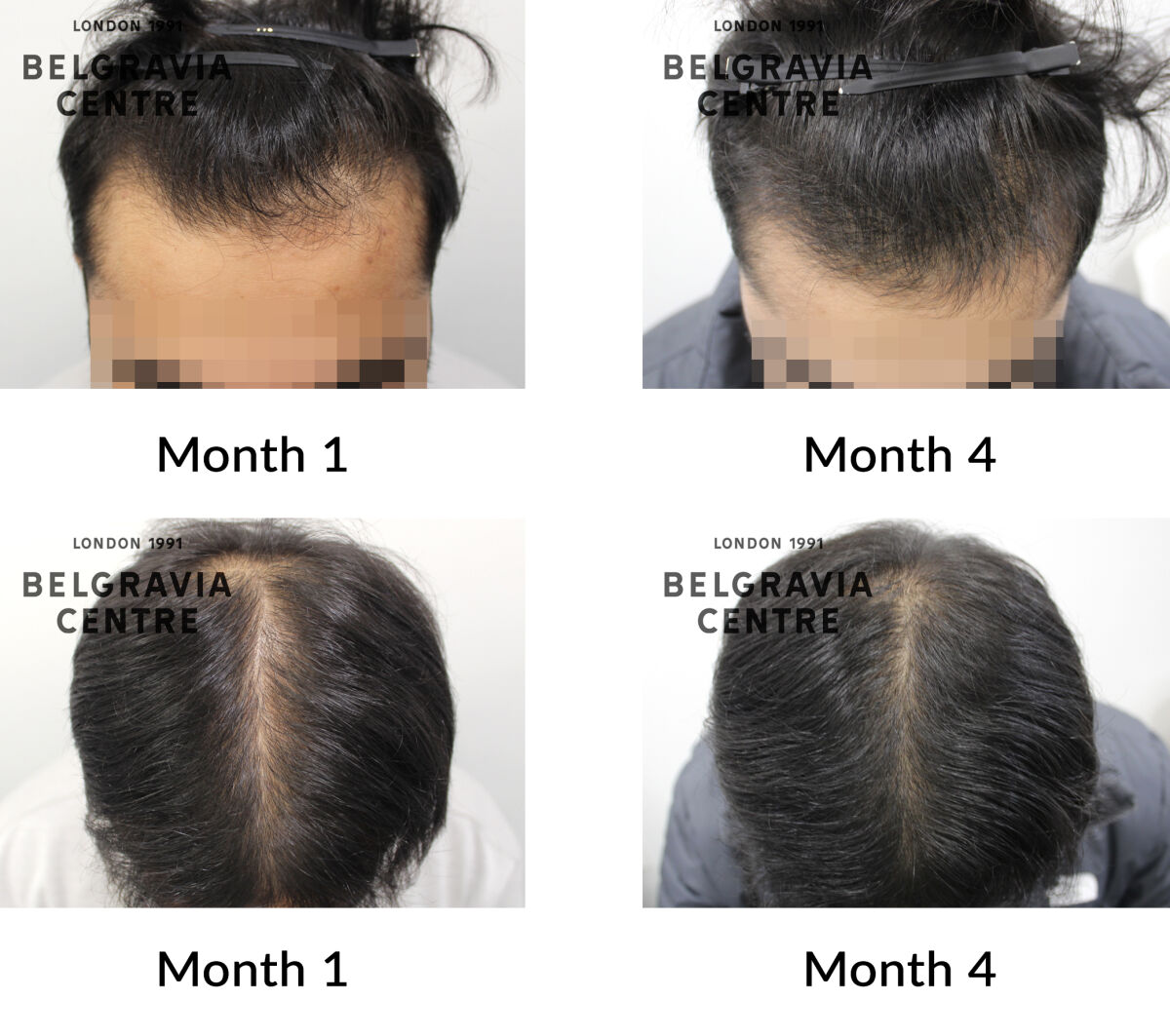 male pattern hair loss the belgravia centre 448587