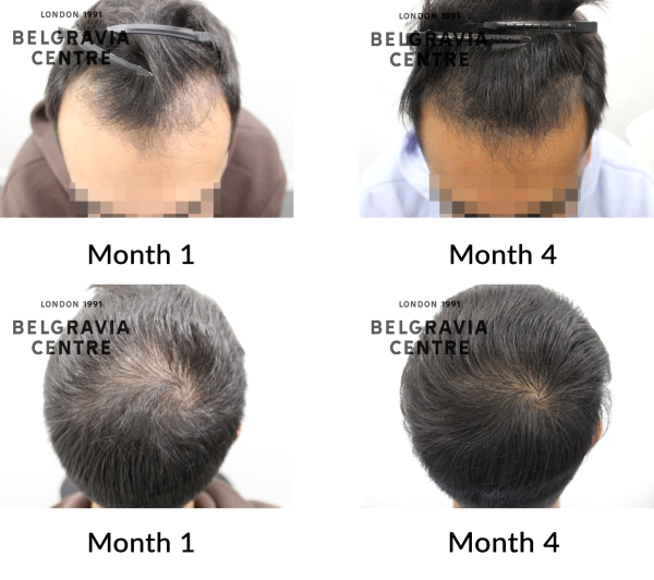 male pattern hair loss the belgravia centre 456246