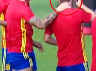 Nolito Bald Patch Hair Loss Football Manchester City Spain