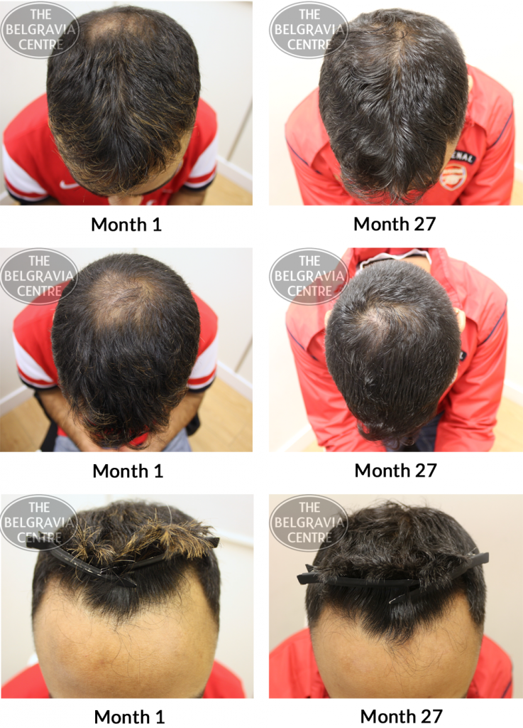 Male Pattern Hair Loss The Belgravia Centre AJ 02 04 737x1024