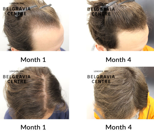male pattern hair loss the belgravia centre 450811