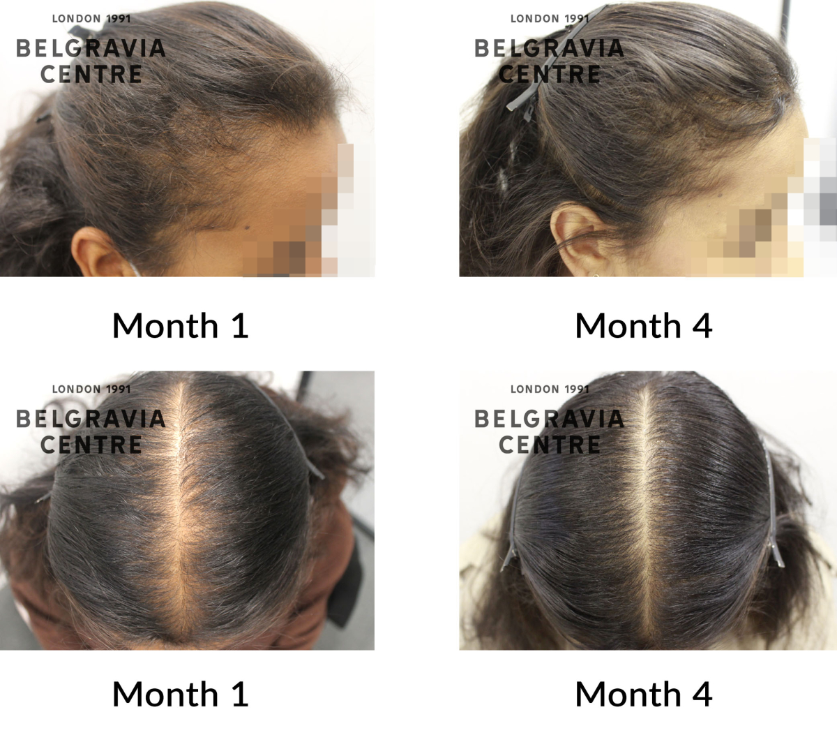 female pattern hair loss and diffuse thinning the belgravia centre 433357
