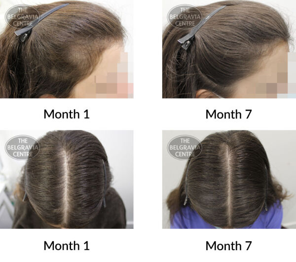 female pattern hair loss the belgravia centre 395083 16 09 2020