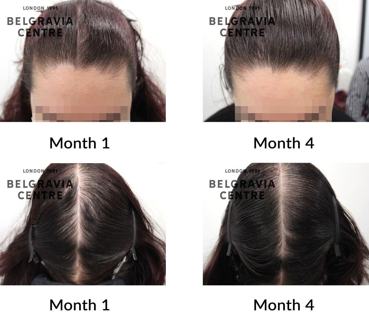 female pattern hair loss and diffuse hair loss the belgravia centre 433950