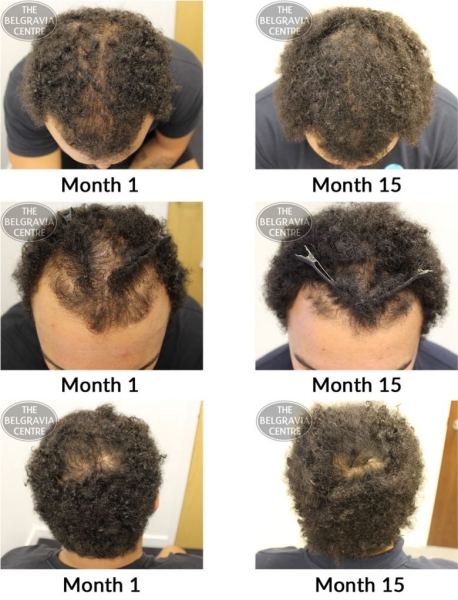male pattern hair loss the belgravia centre ap 06 12 780x1024
