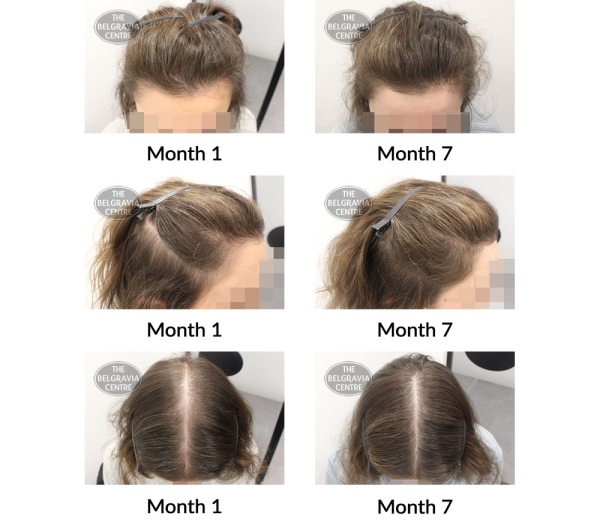 female pattern hair loss the belgravia centre 408630 10 05 2021