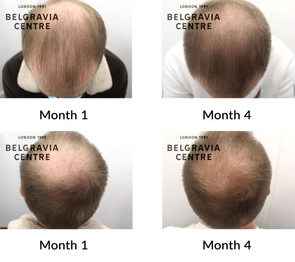 male pattern hair loss the belgravia centre 436610