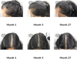 female pattern hair loss the belgravia centre 382509 27 07 2021