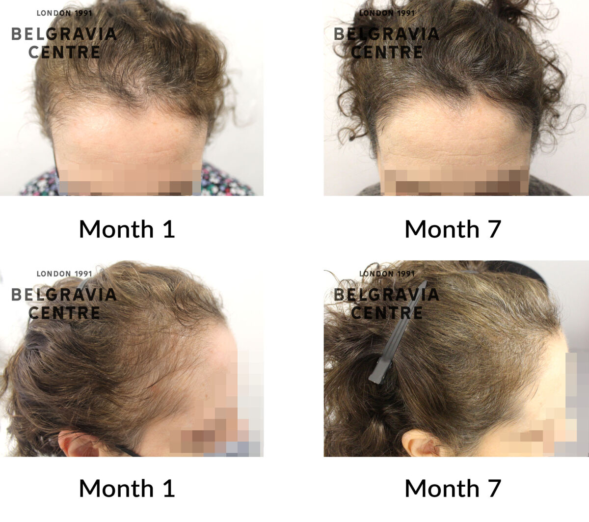 female pattern hair loss the belgravia centre 432636