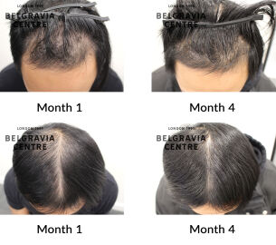 male pattern hair loss the belgravia centre 449733