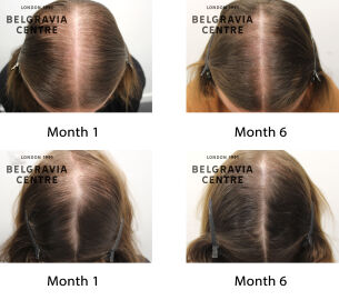 male pattern hair loss the belgravia centre 438000