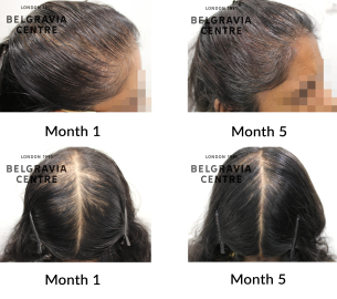 female pattern hair loss the belgravia centre 466213