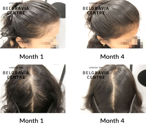 female pattern hair loss the belgravia centre 445370