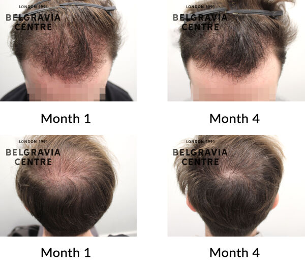 male pattern hair loss the belgravia centre 443886