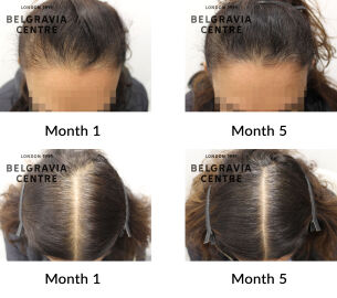 female pattern hair loss the belgravia centre 446612