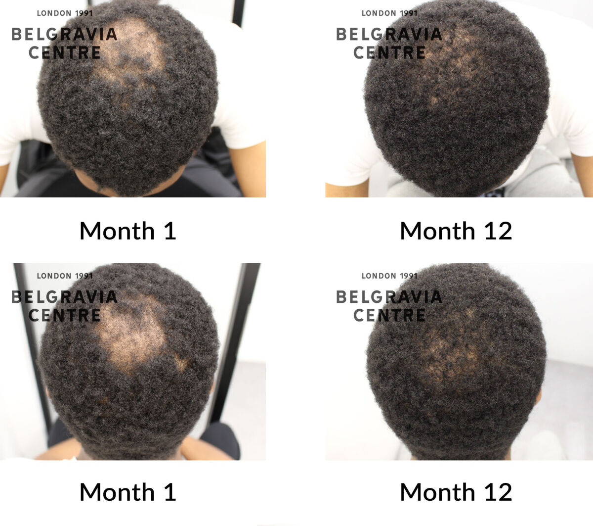 male pattern hair loss the belgravia centre 422262