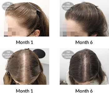 alert female pattern hair loss the belgravia centre 423252 16 11 2021