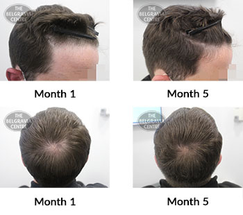 alert male pattern hair loss the belgravia centre 423238 13 10 2021