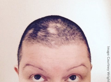 Woman Shaves Head to Cope With Trichotillomania Hair Loss The Belgravia Centre Blog