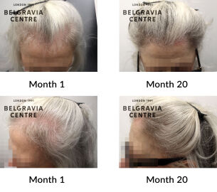 female pattern hair loss and diffuse hair loss the belgravia centre 407211