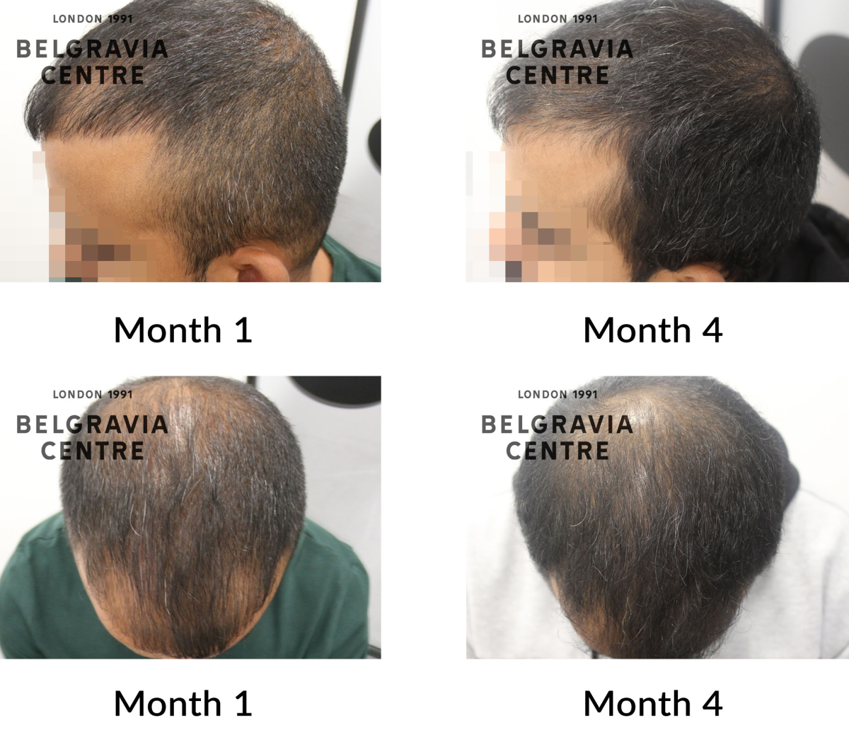 male pattern hair loss the belgravia centre 441513