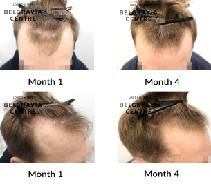 male pattern hair loss the belgravia centre 468722