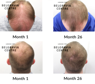 male pattern hair loss the belgravia centre 427928