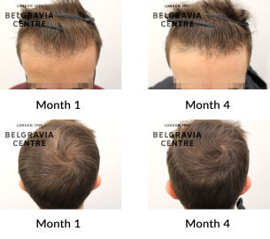 male pattern hair loss the belgravia centre 432919