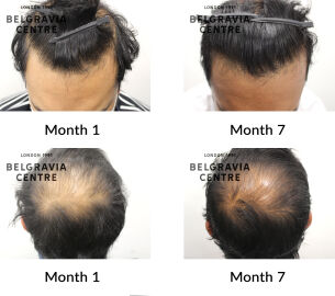 male pattern hair loss the belgravia centre 435741