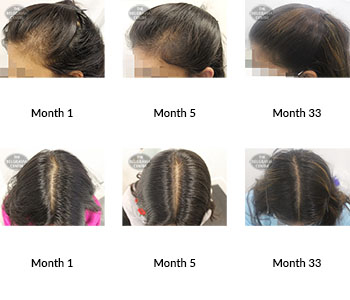 alert female pattern hair loss and telogen effluvium the belgravia centre 337249 30 06 2021