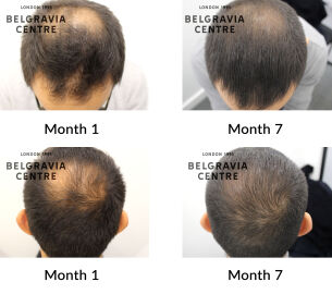 male pattern hair loss the belgravia centre 445932