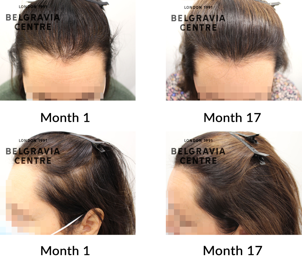female pattern hair loss the belgravia centre 435923