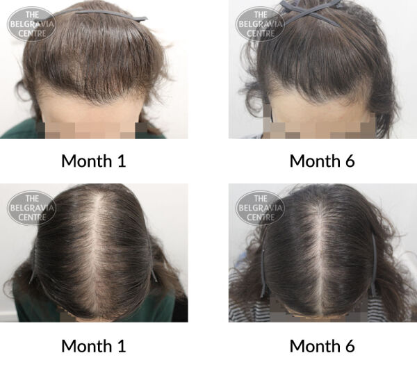 female pattern hair loss the belgravia centre 397418 26 08 2020
