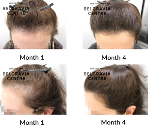 telogen effluvium chronic and female pattern hair loss the belgravia centre 464798