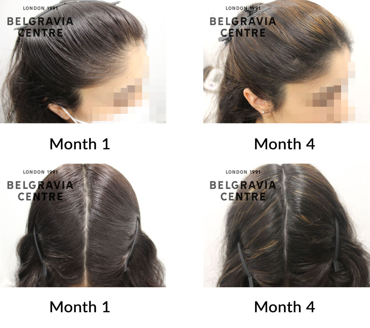 telogen effluvium and female pattern hair loss the belgravia centre 437861