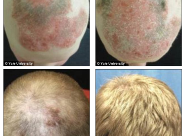 Arthritis Drug Used to Treat Hair Loss from Alopecia Universalis