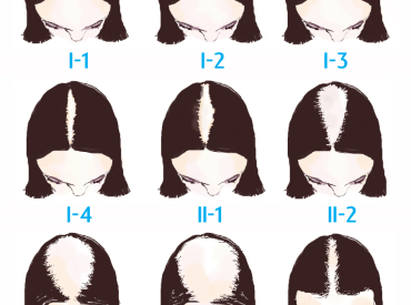 The Ludwig Scale of Womens Hair Loss.jpg