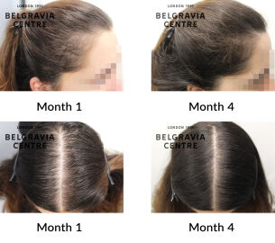 female pattern hair loss the belgravia centre 448688