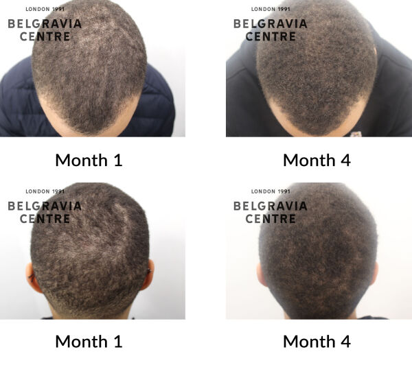 male pattern hair loss the belgravia centre 433012