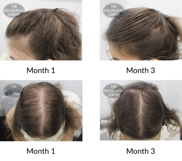 female pattern hair loss the belgravia centre 427218 131121