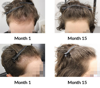 alert diffuse hair loss and female pattern hair loss the belgravia centre 395839 14 05 2021