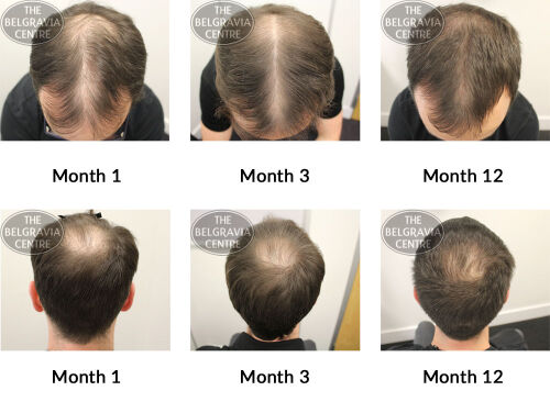 male pattern hair loss the belgravia centre JP 04 01 2019