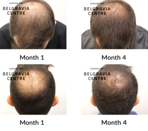 male pattern hair loss the belgravia centre 451991