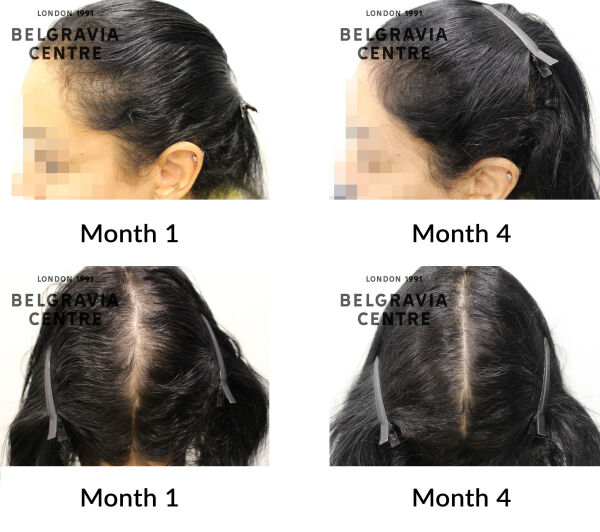 female pattern hair loss the belgravia centre  447986