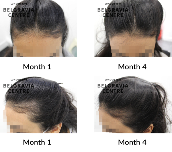 female pattern hair loss the belgravia centre 434446