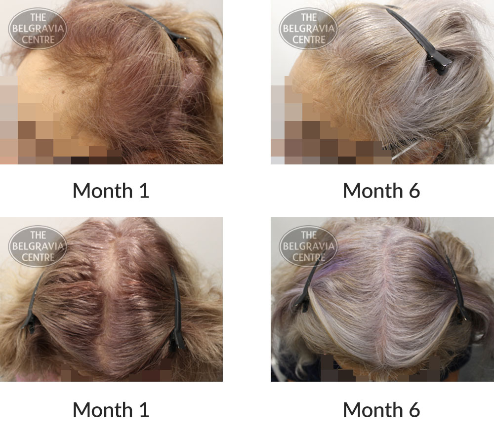 female pattern hair loss the belgravia centre 395017 18 10 2020