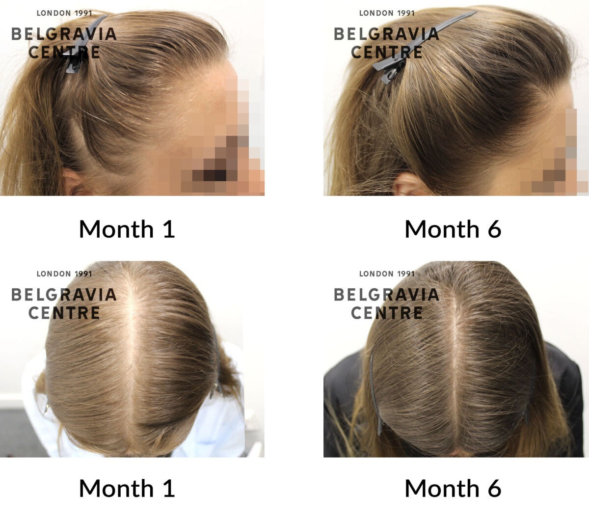 female pattern hair loss and diffuse hair loss the belgravia centre 444246