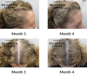telogen effluivium and female pattern hair loss the belgravia centre 433676